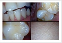 Câmera Intraoral/ Simulação